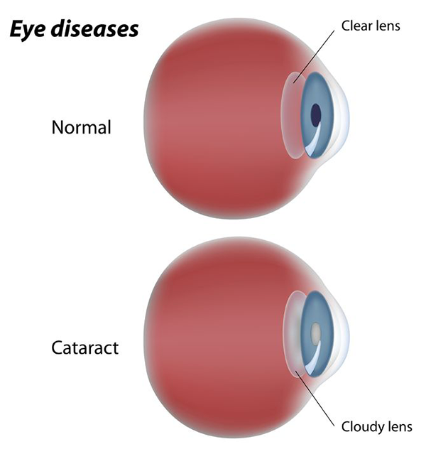 cataracts in paterson