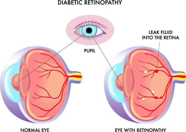 diabetic retinopathy in paterson