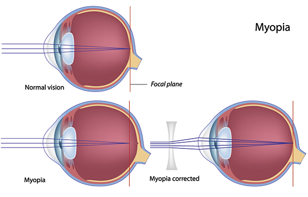 nearsightedness in paterson