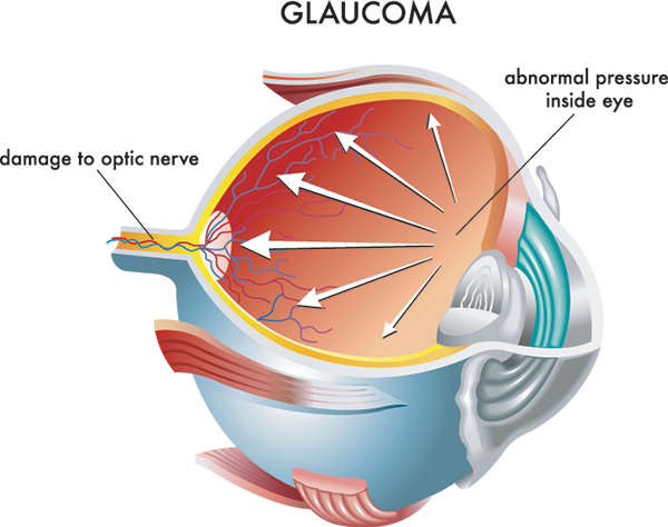 glaucoma treatment in paterson