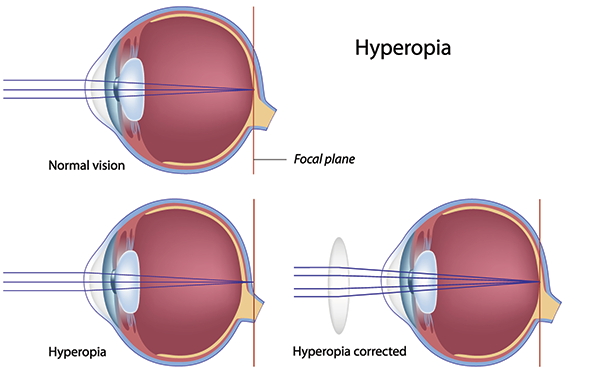 farsighted treatment in paterson